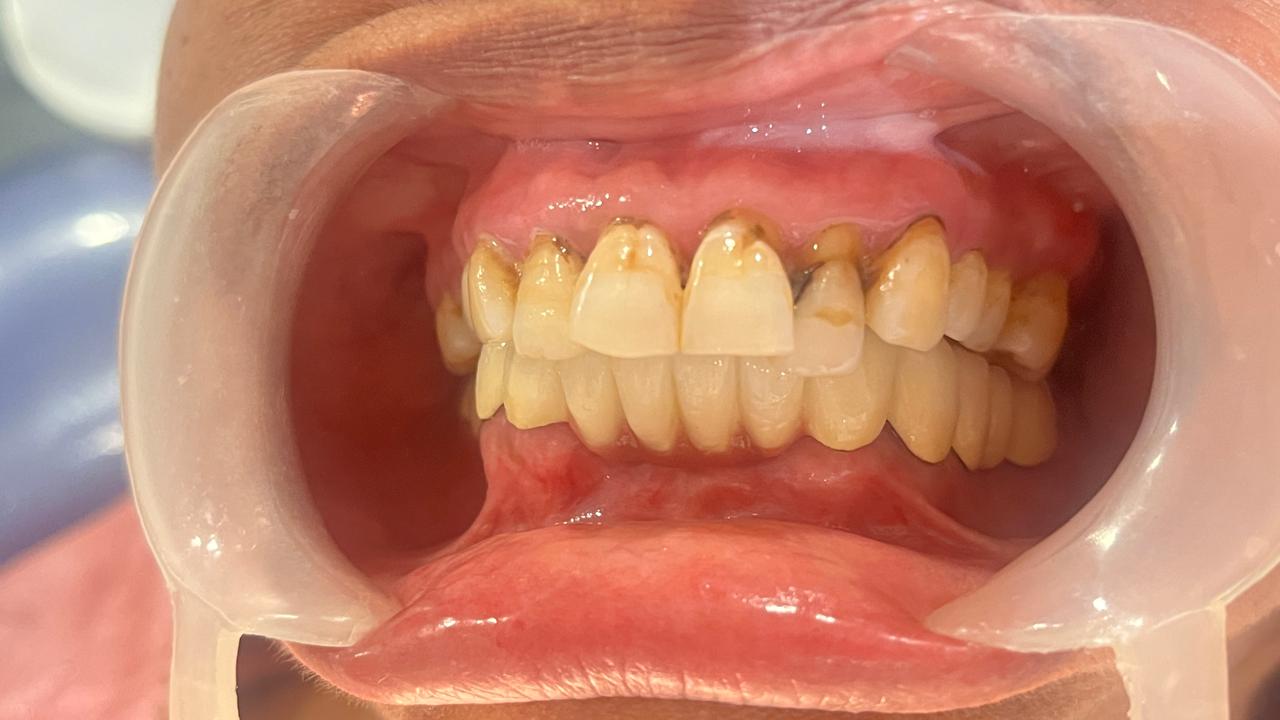 After — Full-mouth rehabilitation with lower complete prosthesis at Shreeji Dental