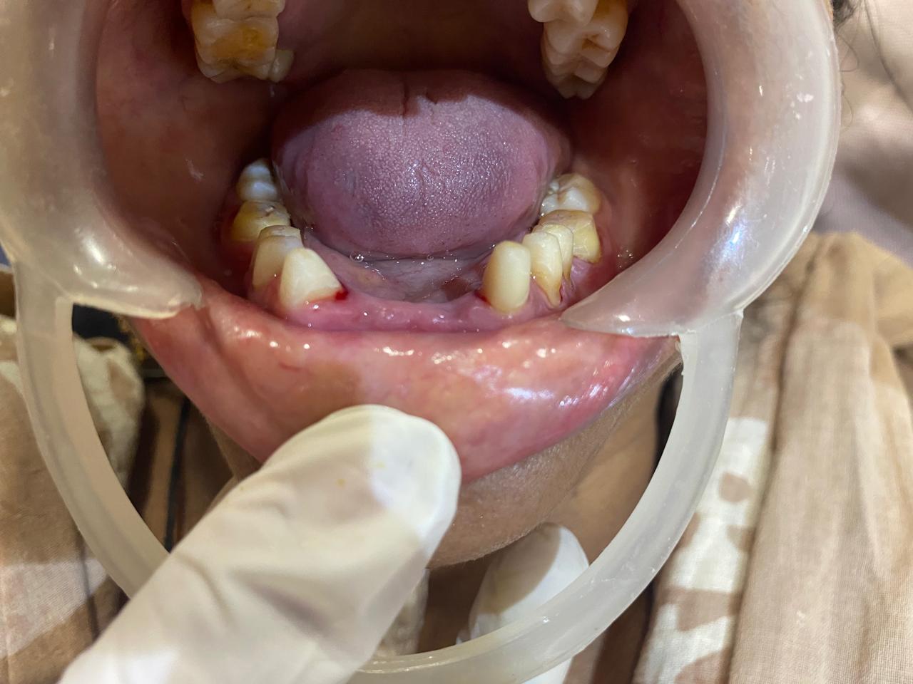 Before — Full-mouth rehabilitation with lower complete prosthesis at Shreeji Dental