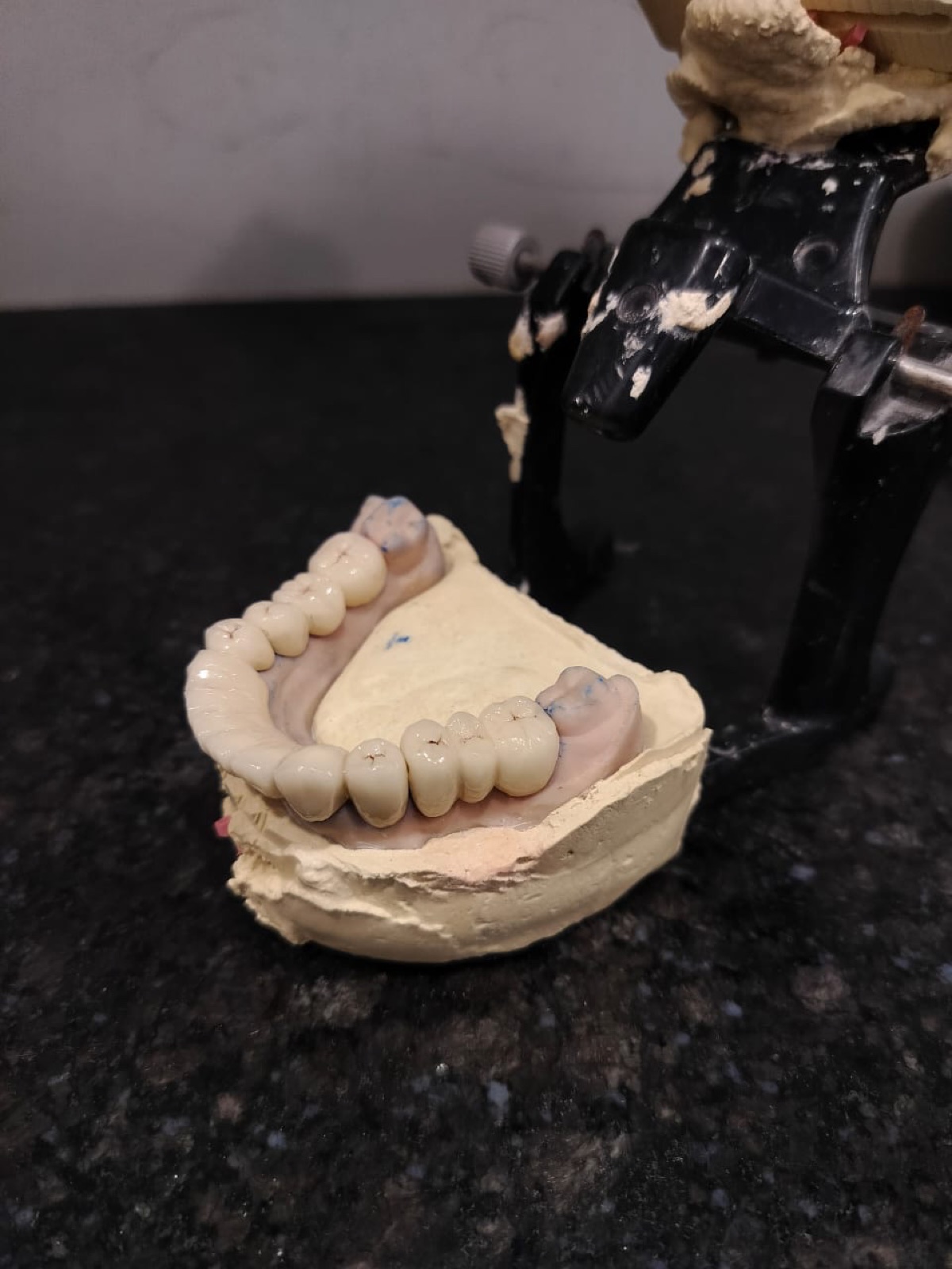 Mid-treatment: impression and bite registration for the lower complete denture, captured at the chair.
