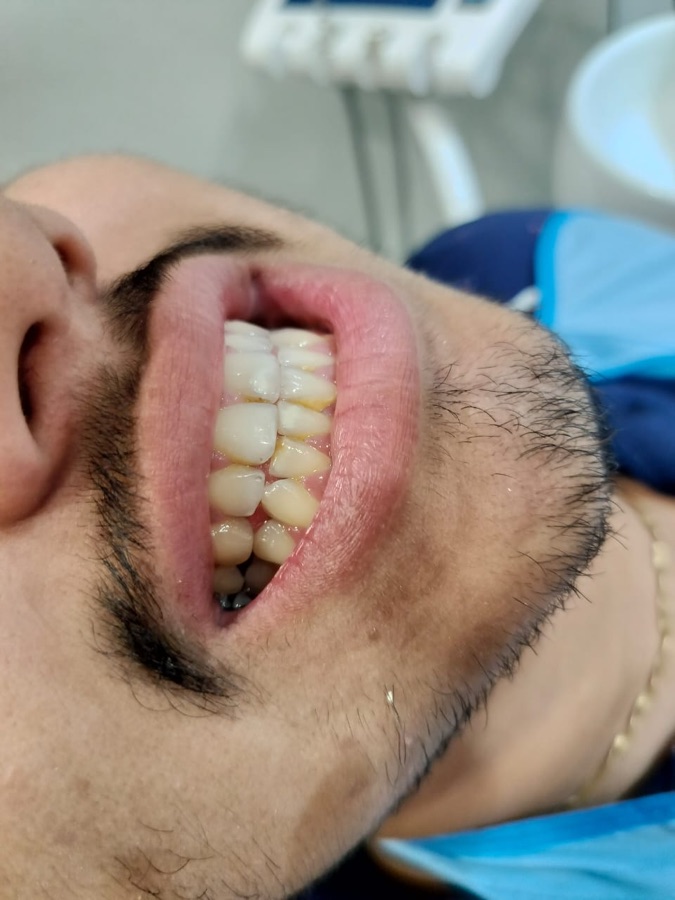 After — Professional cleaning & stain removal at Shreeji Dental